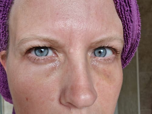Customer photo review of Dark Circles Treatment