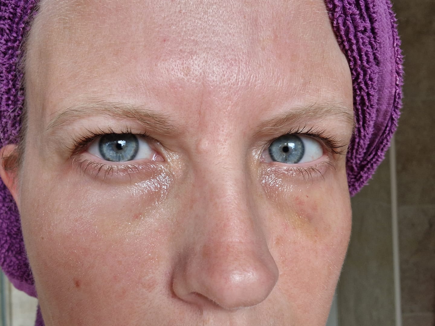 Customer photo review of Dark Circles Treatment