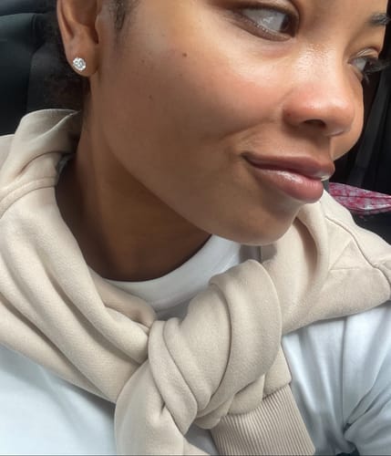 Customer photo review of FaceFix: Sculptra