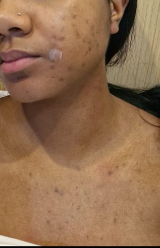 Customer photo review of Anti-Acne & Dark Spots African Soap