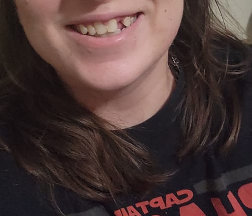 Customer photo review of Upper Partial Denture Retainer (1 Tooth Only)