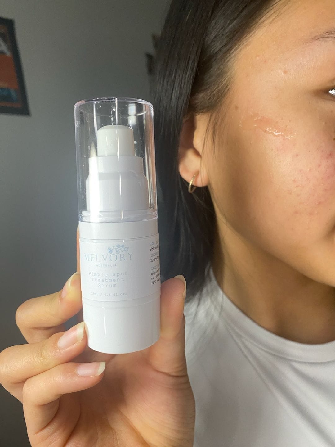 Customer photo review of Pimple Spot Treatment Serum