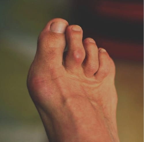 Customer photo review of LOVILDS™ Bee Toxin &𝐓𝐮𝐫𝐦𝐞𝐫𝐢𝐜 𝐀𝐫𝐭𝐡𝐫𝐢𝐭𝐢𝐬 𝐓𝐡𝐞𝐫𝐚𝐩𝐲 𝐂𝐫𝐞𝐚𝐦(👩‍🔬𝐒𝐩𝐞𝐜𝐢𝐚𝐥𝐢𝐳𝐢𝐧𝐠 𝐢𝐧 𝐨𝐫𝐭𝐡𝐨𝐩𝐞𝐝𝐢𝐜 𝐜𝐨𝐧𝐝𝐢𝐭𝐢𝐨𝐧𝐬 𝐚𝐧𝐝 𝐣𝐨𝐢𝐧𝐭 𝐩𝐚𝐢𝐧👩‍🔬