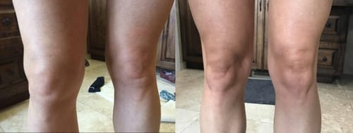 Customer photo review of LOVILDS™ Bee Toxin &𝐓𝐮𝐫𝐦𝐞𝐫𝐢𝐜 𝐀𝐫𝐭𝐡𝐫𝐢𝐭𝐢𝐬 𝐓𝐡𝐞𝐫𝐚𝐩𝐲 𝐂𝐫𝐞𝐚𝐦(👩‍🔬𝐒𝐩𝐞𝐜𝐢𝐚𝐥𝐢𝐳𝐢𝐧𝐠 𝐢𝐧 𝐨𝐫𝐭𝐡𝐨𝐩𝐞𝐝𝐢𝐜 𝐜𝐨𝐧𝐝𝐢𝐭𝐢𝐨𝐧𝐬 𝐚𝐧𝐝 𝐣𝐨𝐢𝐧𝐭 𝐩𝐚𝐢𝐧👩‍🔬