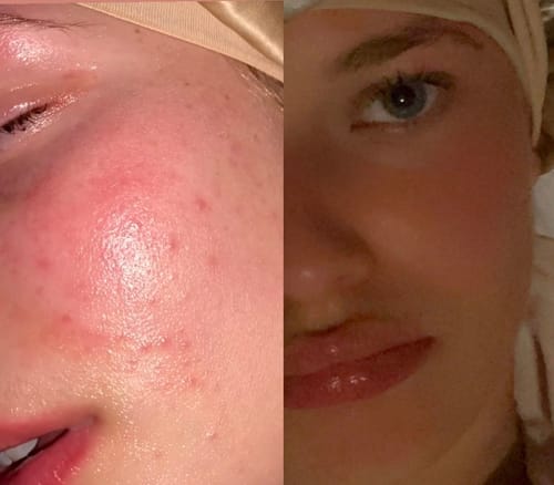 Customer photo review of Anti-Acne & Dark Spots African Soap