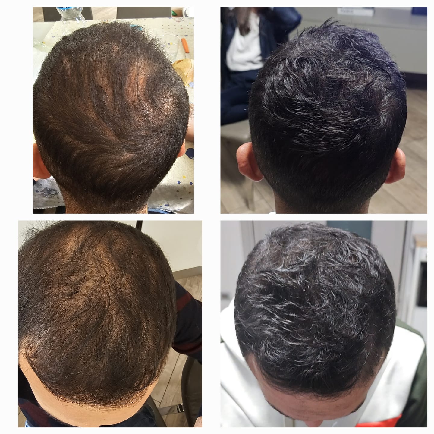 Customer photo review of Fibre copri Calvizie da 27.5gr  | Castano Scuro | 60 Giorni di applicazioni