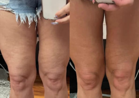 Customer photo review of CelluLuxe Pro - Straffe deinen Körper in nur 10 Minuten täglich ganz bequem von zu Hause.