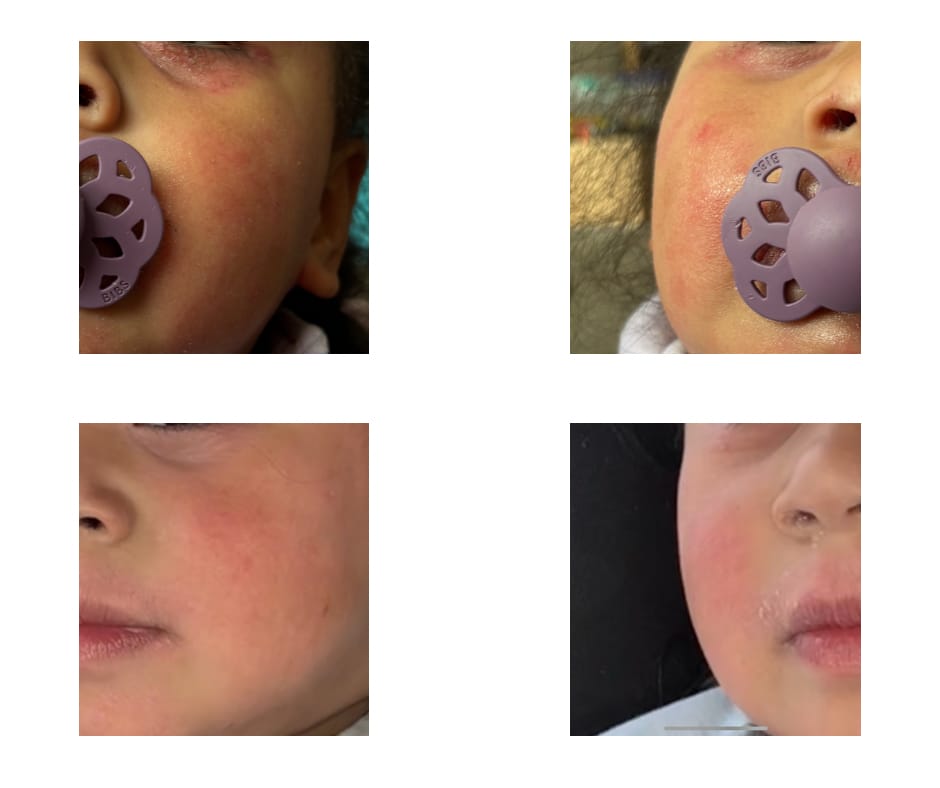 Customer photo review of Kawakawa Repair Balm - Winner, Best SOS/Healing Balm 2024
