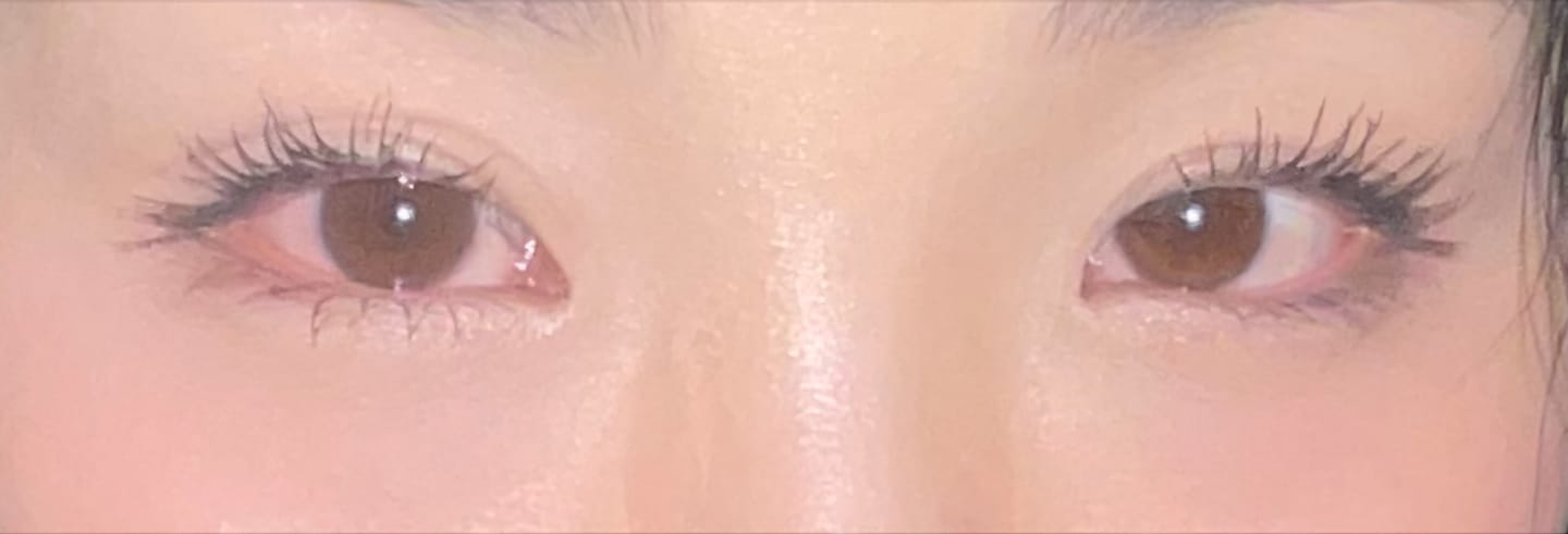 Customer photo review of Optifold Eyelid Tapes - Create Double Eyelids + Fix Uneven, Droopy, Hooded Eyelids