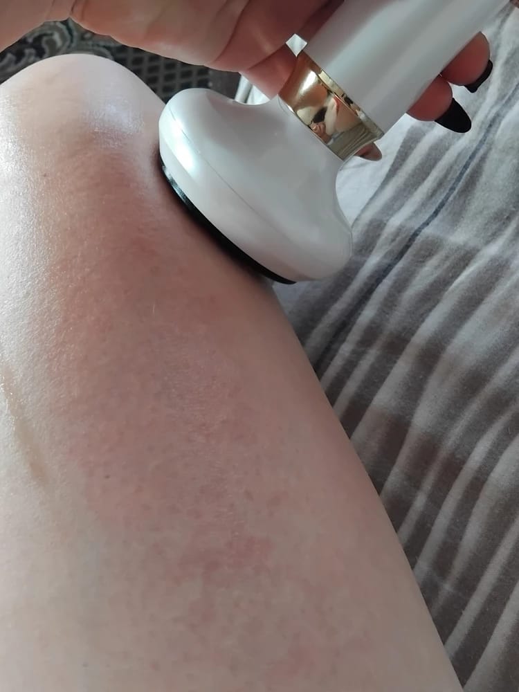 Customer photo review of Revimus Anti-Cellulite Massager