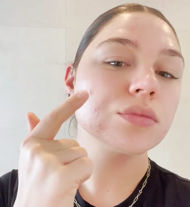 Customer photo review of Anti Acne (Azelaic Acid 20% w/w & Niacinamide) (30ml)
