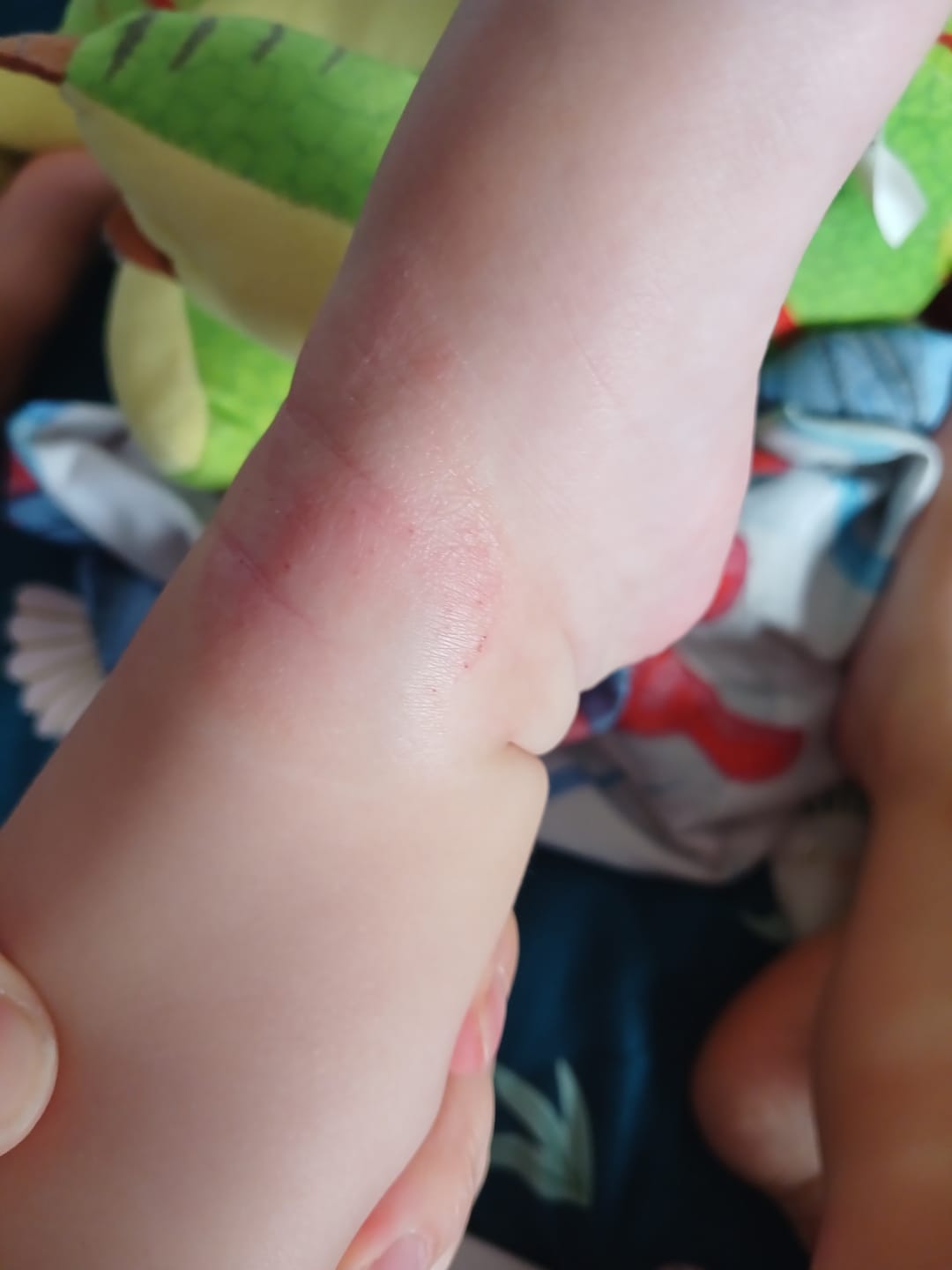Customer photo review of Bioskin Junior Outbreak Rescue Cream
