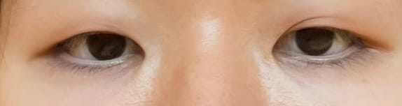 Customer photo review of Optifold Eyelid Tapes - Create Double Eyelids + Fix Uneven, Droopy, Hooded Eyelids