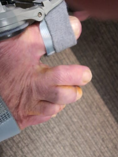 Customer photo review of Treatmedy™ Bunion Fix - Natural At-Home Bunion Relief