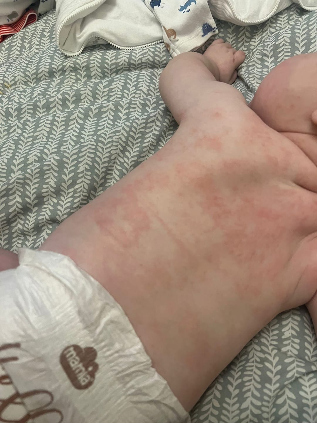 Customer photo review of Bioskin Junior Duo Pack (Free Outbreak Rescue Cream)