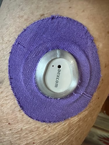 Customer photo review of Skin Grip Original - Freestyle Libre 2/Pump Adhesive Patches