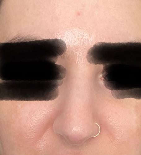 Customer photo review of NoseFix: Botox