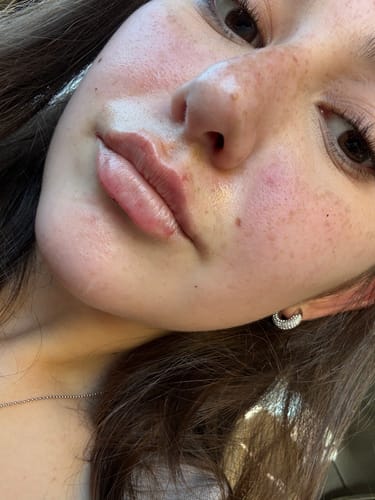 Customer photo review of LipFix: Filler