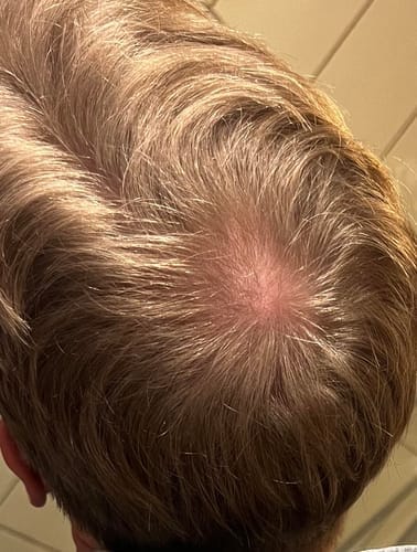 Customer photo review of Novaxidil Triple Therapy Hair Regrowth Foam