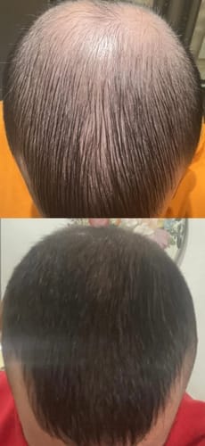 Customer photo review of Novaxidil Triple Therapy Hair Regrowth Foam