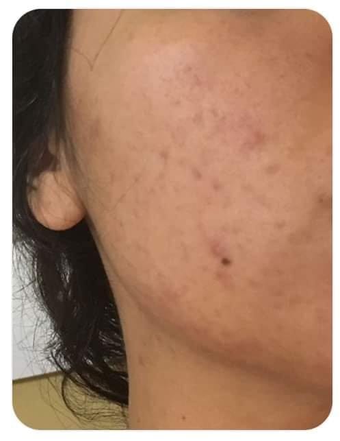 Customer photo review of Kit Acné