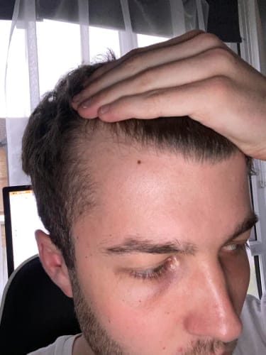 Customer photo review of Novaxidil Triple Therapy Hair Regrowth Foam
