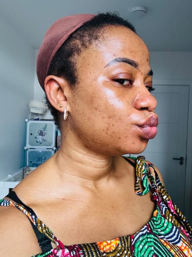 Customer photo review of Anti-Acne & Dark Spots African Soap