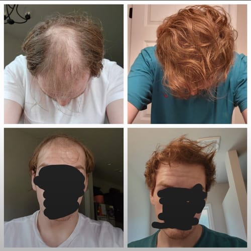 Customer photo review of Novaxidil Triple Therapy Hair Regrowth Foam