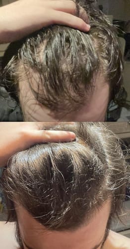 Customer photo review of Novaxidil Triple Therapy Hair Regrowth Foam