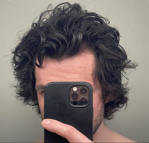 Customer photo review of Novaxidil Triple Therapy Hair Regrowth Foam