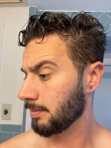 Customer photo review of Novaxidil Triple Therapy Hair Regrowth Foam