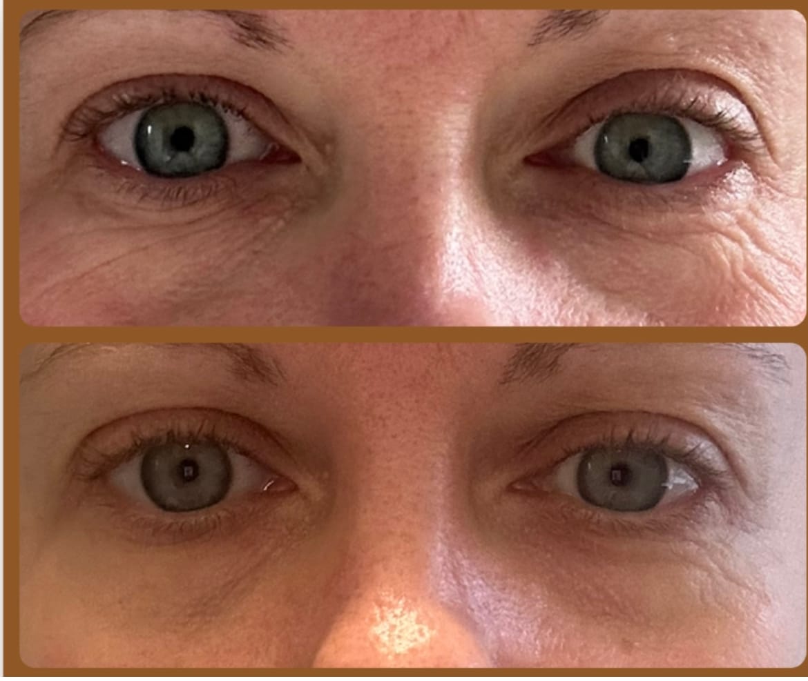 Customer photo review of Anti-Fatigue Eye Mask