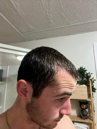 Customer photo review of Novaxidil Triple Therapy Hair Regrowth Foam