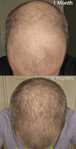 Customer photo review of Novaxidil Triple Therapy Hair Regrowth Foam