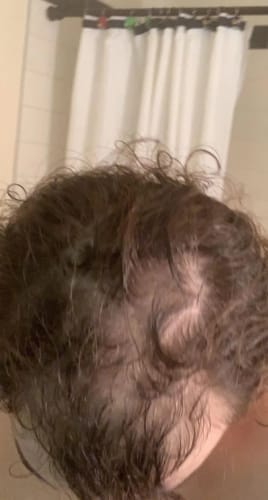 Customer photo review of Novaxidil Triple Therapy Hair Regrowth Foam
