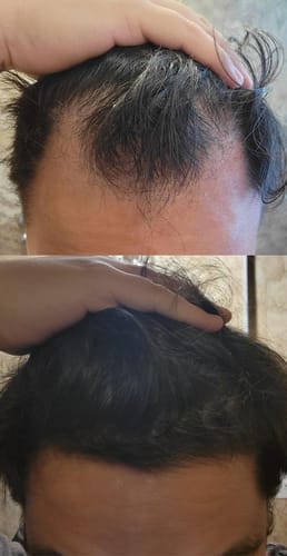 Customer photo review of Novaxidil Triple Therapy Hair Regrowth Foam