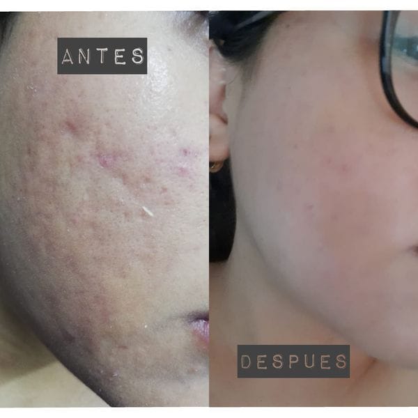 Customer photo review of Kit Acné