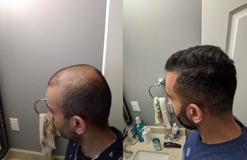 Customer photo review of Novaxidil Triple Therapy Hair Regrowth Foam