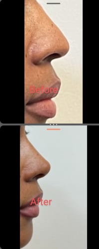 Customer photo review of NoseFix: Filler