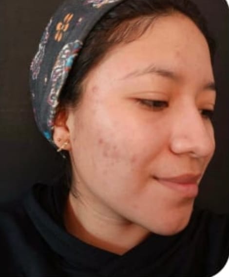 Customer photo review of Kit Acné