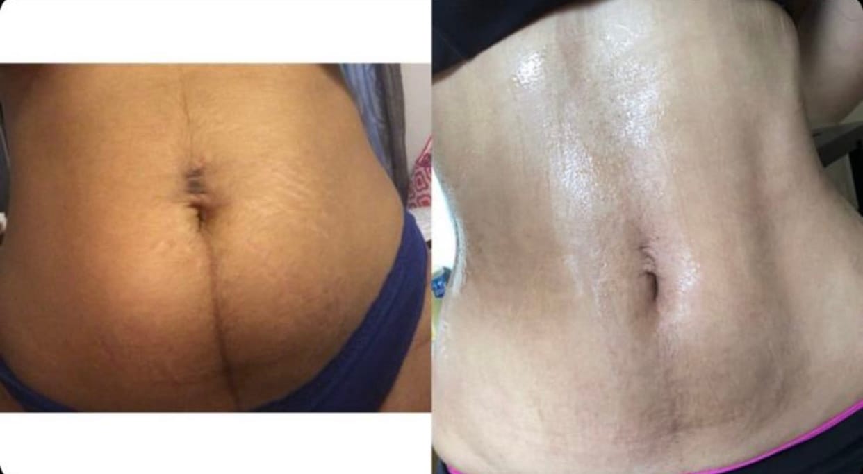 Customer photo review of Gel Minceur™