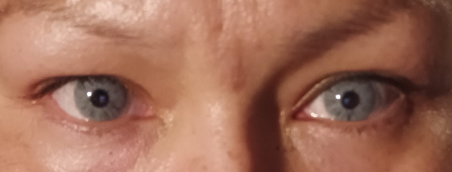 Customer photo review of Clover Green Prescription Colored Contact Lenses