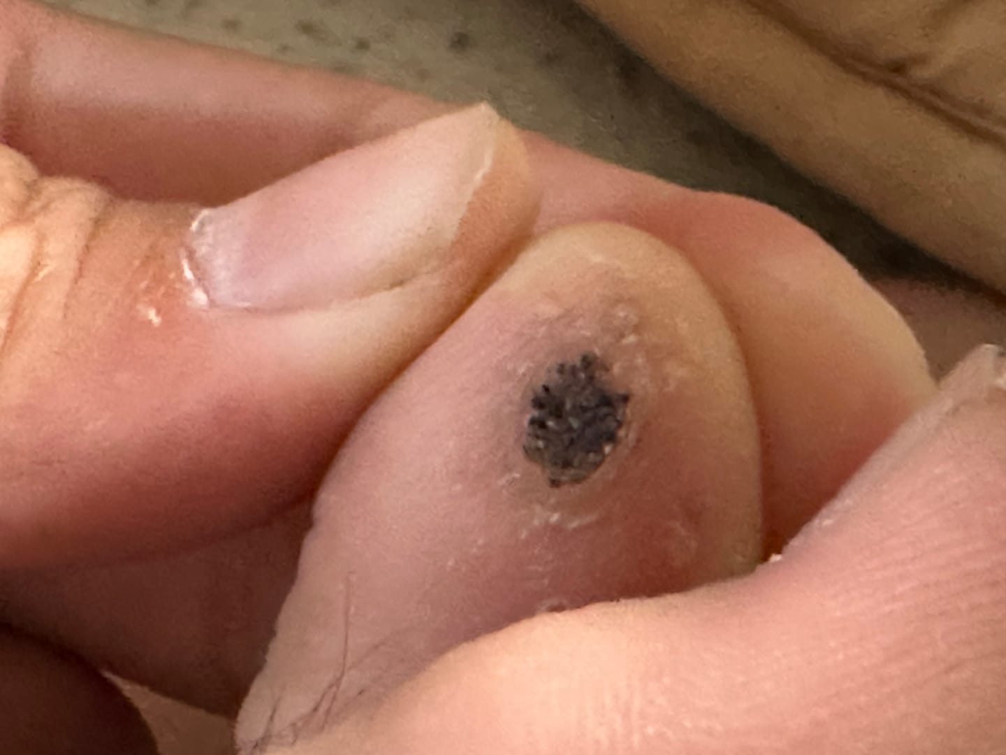 Customer photo review of The Wartabater | Electronic Wart Remover | Safe, Easy, & Effective