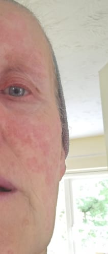 Customer photo review of Blemish Gel