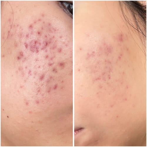 Customer photo review of Effaclar Gel Facial Wash For Oily Skin