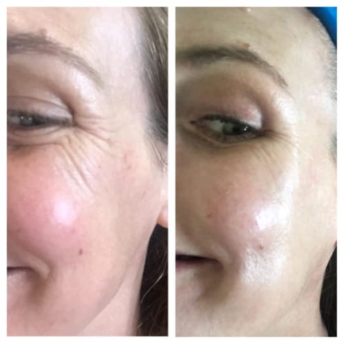 Customer photo review of Luminous Face Lift Bundle - Sale