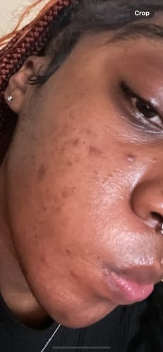 Customer photo review of Duo Pack | Discoloration Brightening Corrector | Oat Relief Acne Exfoliant