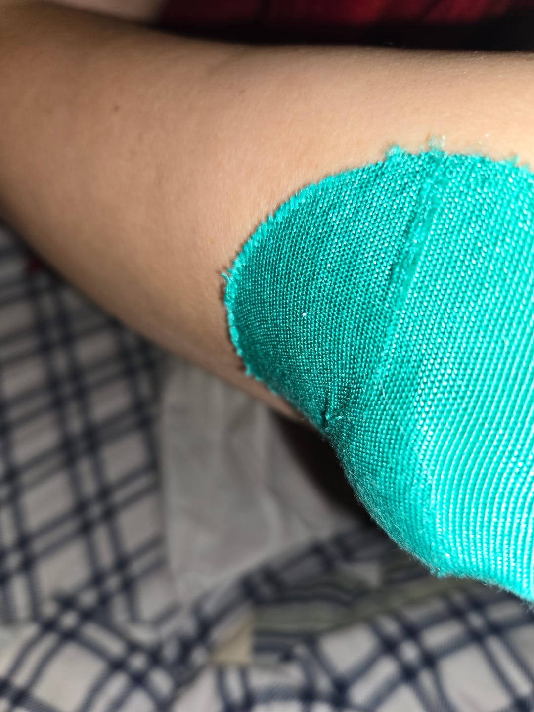 Customer photo review of Skin Grip Original - Medtronic Guardian/Enlite Adhesive Patches