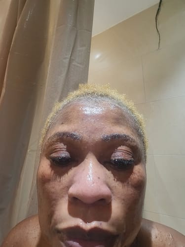 Customer photo review of Anti-Acne & Dark Spots African Soap