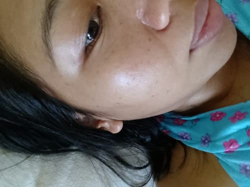 Customer photo review of Bad Skin™ Korean Collagen Bomb Hydrating Ampoule